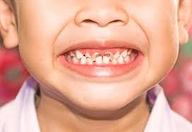 پوسیدگی دندان‌ها در کودکان