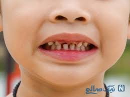 عوامل شکل‌گیری نامناسب دندان کودکان چیست؟
