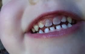 علل لکه‌های دندانی در کودکان چیست؟