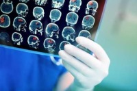 الگوریتم‌های رایانه ای در تشخیص تومور مغزی از پزشکان موفق ترند