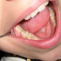 دندان‌های پوسیده کودکان 12 ساله ایرانی رو به افزایش است