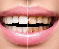 چرا دچار پوسیدگی دندان می‌شویم؟
