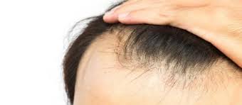ریزش موی شما ممکن است به 6 دلیل پزشکی باشد