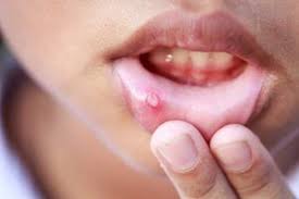 10 درمان خانگی آفت دهان