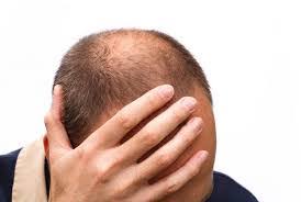 ریزش مو نشانه کدام بیماری است؟ + راه‌های درمان