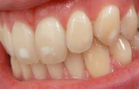 علت وجود لکه‌های سفید روی دندان‌ها چیست؟