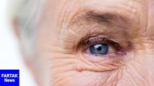 شناسایی آلزایمر با تغییرات شبکیه چشم