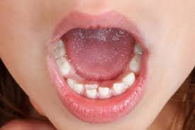دندان‌های شیری از چه سنی می‌ریزد؟