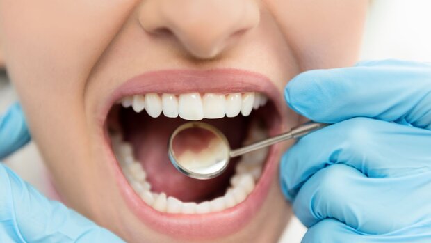 عمر مفید ایمپلنت‌های دندانی 10 سال است