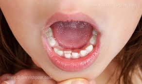 رشد دندانهای کودکان تا چند سالگی کامل می‌شود؟