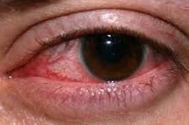 چگونه قرمزی سطح چشم را درمان کنیم؟