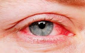 بیماری‌های التهابی چشم جدی گرفته شود
