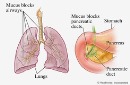 تاثیر ورزش بر کیفیت زندگی بیماران COPD